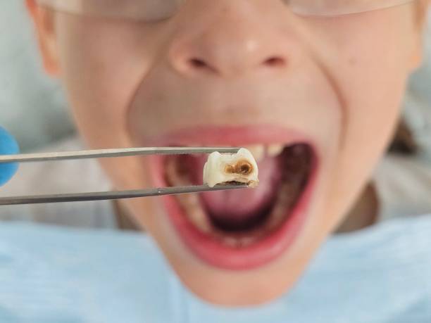 Best Emergency Tooth Extraction in Pascagoula, MS